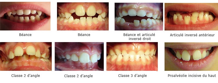 05 orthodontie fonctionnelle blog